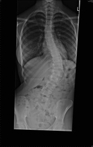 An example of scoliosis - courtesy of the NHS and my daughter, Lizzie